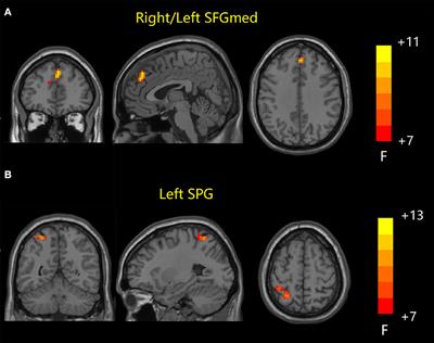 Static and dynamic functional connectivity combined with the triple network model in amnestic mild cognitive impairment and Alzheimer's disease